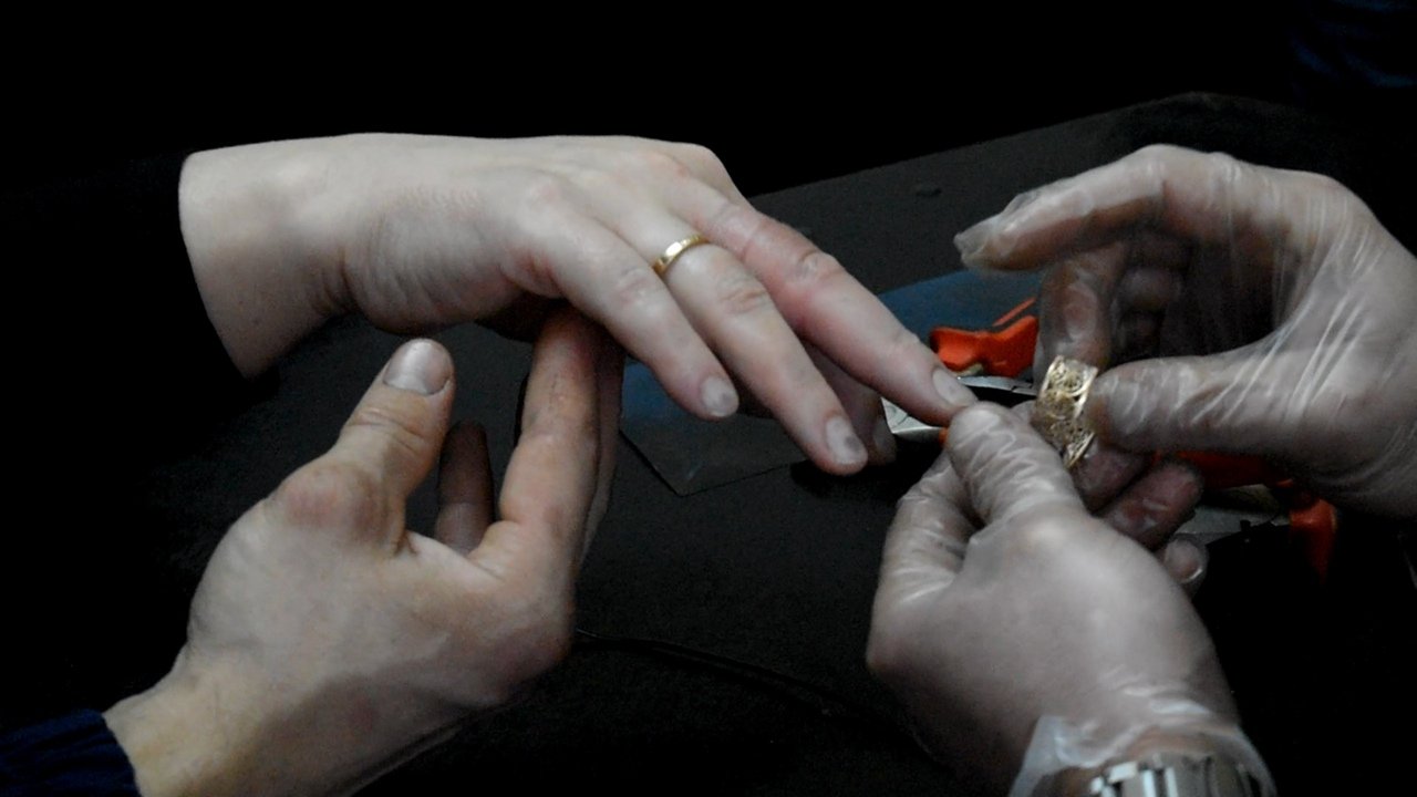 Нападение пальца. Снятие колец с пациента. Как снять кольцо с опухшего пальца.