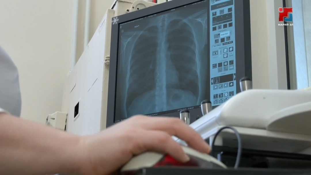 В Марий Эл снизилась заболеваемость туберкулезом